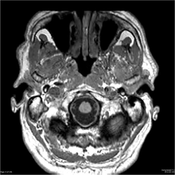 File:Chondrosarcoma of skull base- grade II (Radiopaedia 40948-43654 Axial T1 6).jpg