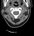 Chordoma (C4 vertebra) (Radiopaedia 47561-52188 Axial non-contrast 13).png