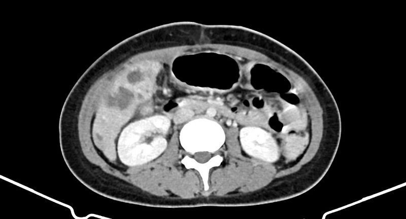 File:Choriocarcinoma liver metastases (Radiopaedia 74768-85766 A 105).jpg