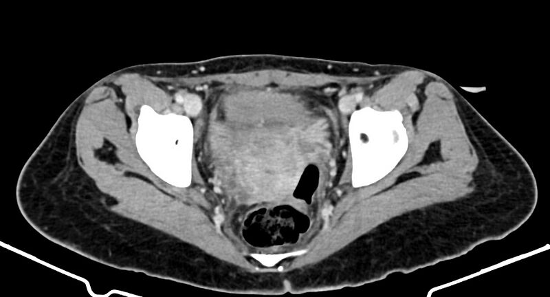 File:Choriocarcinoma liver metastases (Radiopaedia 74768-85766 A 185).jpg