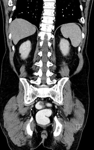 File:Chronic appendicitis complicated by appendicular abscess, pylephlebitis and liver abscess (Radiopaedia 54483-60700 C 63).jpg