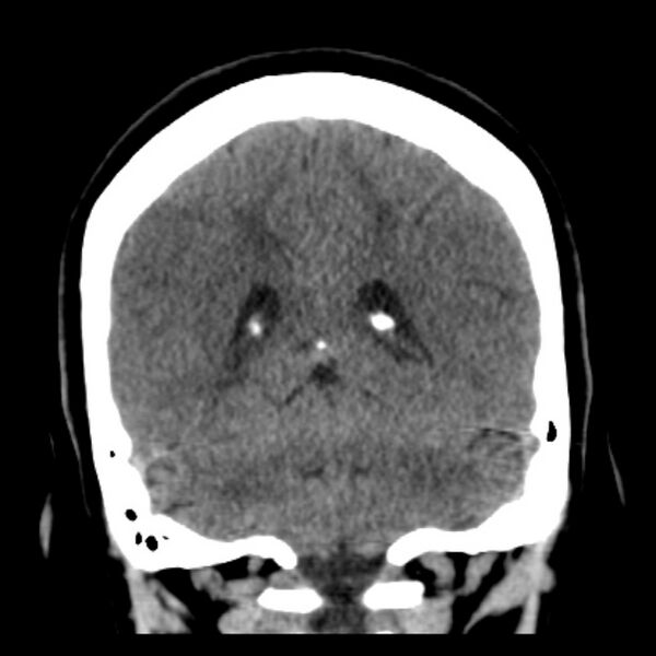 File:Chronic bilateral occipital lobe infarcts (Radiopaedia 31276-31996 Coronal non-contrast 34).jpg