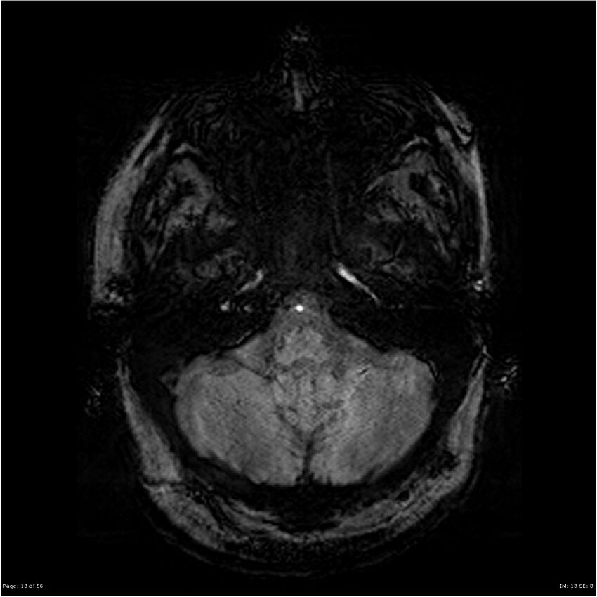 Chronic hypertensive encephalopathy (Radiopaedia 25764-25918 Axial SWI 13).jpg