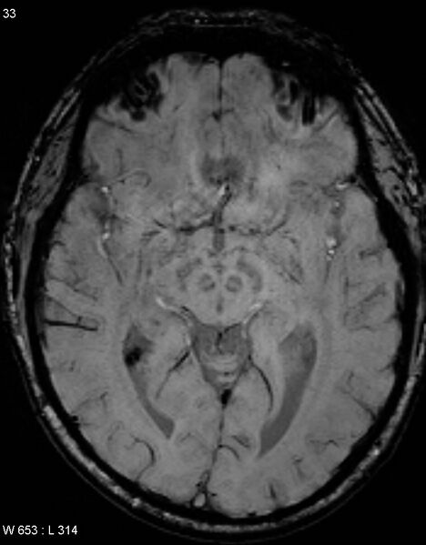 File:Chronic lymphocytic inflammation with pontine perivascular enhancement responsive to steroids (CLIPPERS) (Radiopaedia 37520-39374 Axial SWI 32).jpg