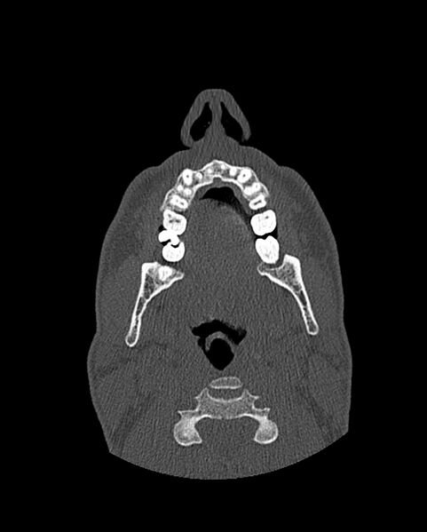 File:Chronic maxillary sinusitis caused by a foreign body (Radiopaedia 58521-65676 Axial bone window 5).jpg