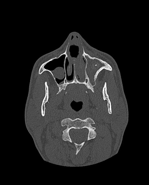 File:Chronic maxillary sinusitis caused by a foreign body (Radiopaedia 58521-65676 Axial bone window 90).jpg