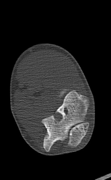 File:Chronic osteomyelitis of the distal humerus (Radiopaedia 78351-90971 Axial bone window 91).jpg