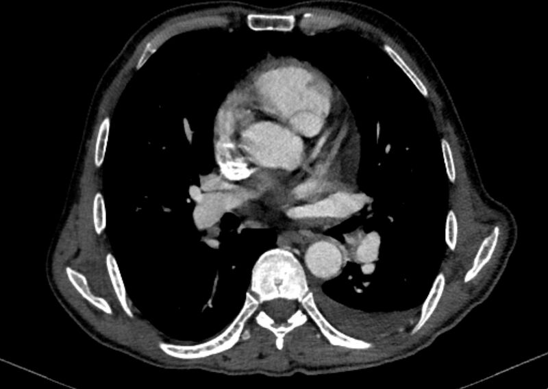 File:Chronic pulmonary embolism with bubbly consolidation (Radiopaedia 91248-108850 C+ arterial phase 79).jpg