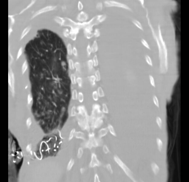 File:Clagett thoracotomy with bronchopleural fistula (Radiopaedia 29192-29587 Coronal lung window 4).jpg