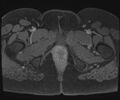 Class II Mullerian duct anomaly- unicornuate uterus with rudimentary horn and non-communicating cavity (Radiopaedia 39441-41755 Axial T1 fat sat 142).jpg