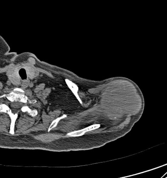 File:Clear cell chondrosarcoma - humerus (Radiopaedia 63104-71612 Axial non-contrast 17).jpg