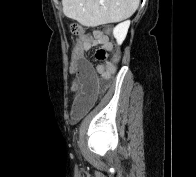 File:Closed loop small bowel obstruction (Radiopaedia 71211-81508 C 139).jpg