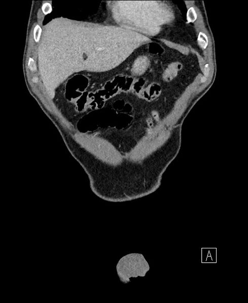 File:Closed loop small bowel obstruction - internal hernia (Radiopaedia 57806-64778 A 18).jpg