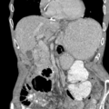 Closed loop small intestinal obstruction (Radiopaedia 16156-15835 Coronal non-contrast 1).png
