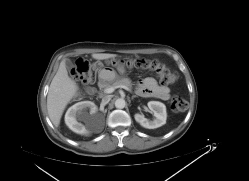 File:Colon cancer mimicking renal cell carcinoma (Radiopaedia 28986-29335 C 24).jpg