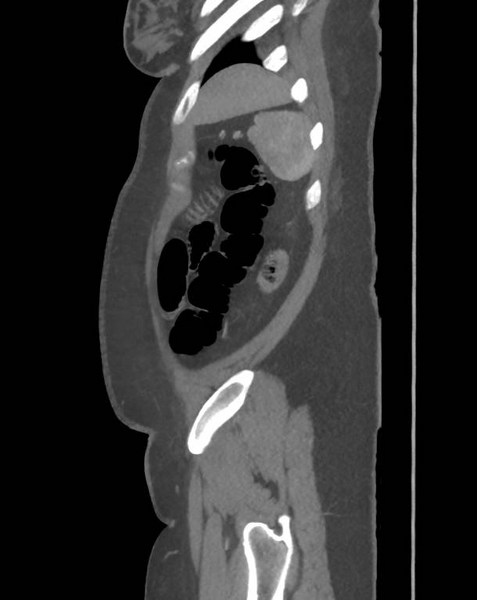 File:Colonic pseudo-obstruction (Radiopaedia 79752-92980 C 65).png