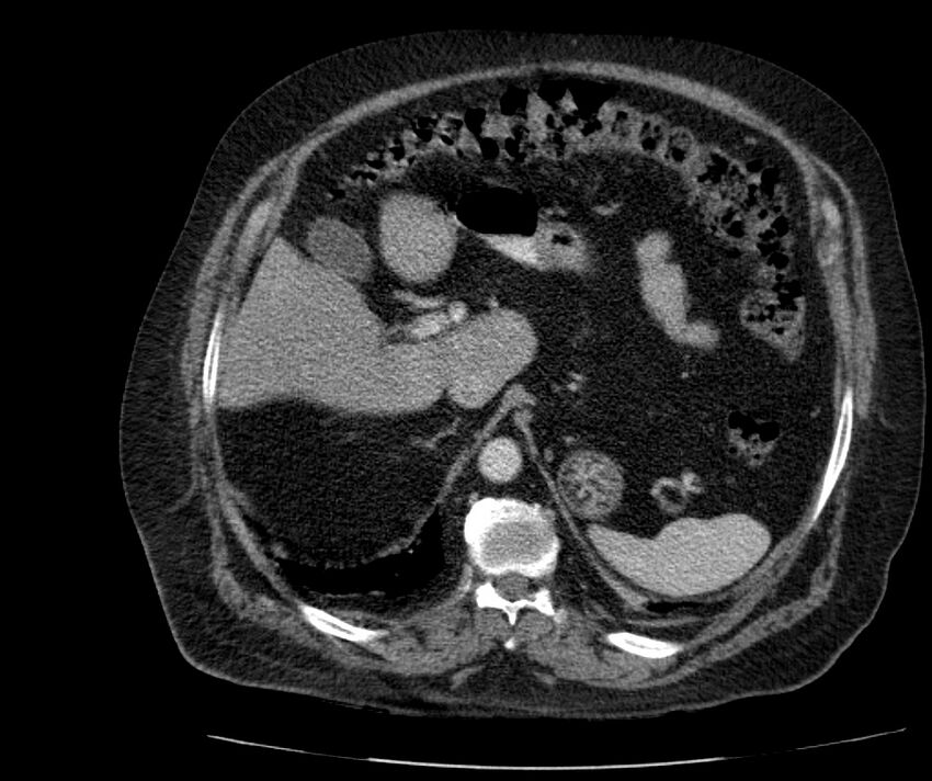 Nephroptosis with inguinal hernia containing perirenal fat (Radiopaedia 56632-63391 C 93).jpg