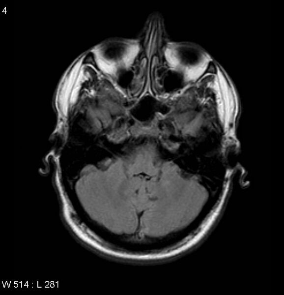 File:Neurosarcoidosis (Radiopaedia 10930-17204 Axial FLAIR 4).jpg