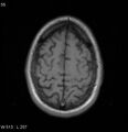Neurosarcoidosis (Radiopaedia 10930-17204 Axial T1 17).jpg