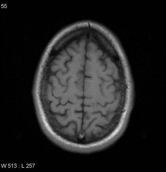 File:Neurosarcoidosis (Radiopaedia 10930-17204 Axial T1 17).jpg
