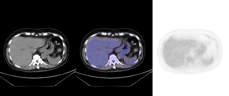 File:Non-Hodgkin lymphoma involving seminal vesicles with development of interstitial pneumonitis during Rituximab therapy (Radiopaedia 32703-33752 ax CT Fus PET 31).jpg