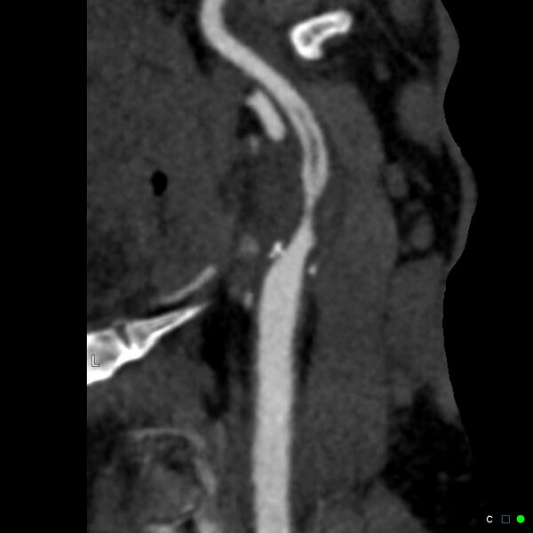 File:Non-occlusive intraluminal internal carotid artery thrombus (Radiopaedia 37751-39658 A 46).jpg