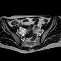 Non-puerperal uterine inversion (Radiopaedia 78343-90983 Axial T2 26).jpg