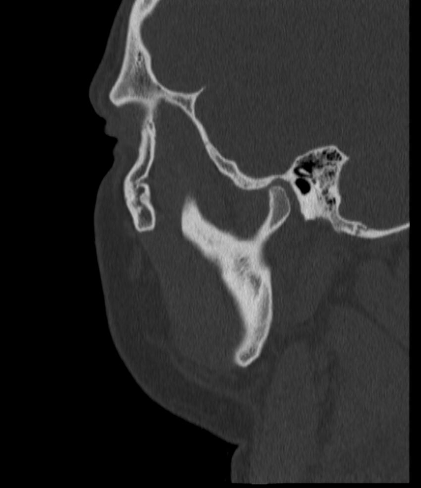Normal facial bone CT (Radiopaedia 88742-105476 Sagittal bone window 133).jpg