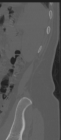 File:Normal lumbosacral CT (Radiopaedia 37923-39867 Sagittal bone window 3).png