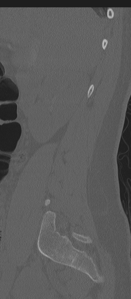File:Normal lumbosacral CT (Radiopaedia 37923-39867 Sagittal bone window 80).png