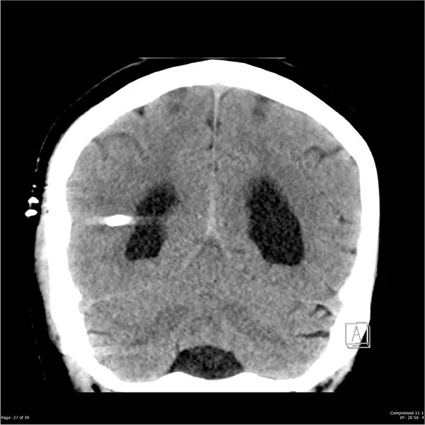 File:Normal pressure hydrocephalus (Radiopaedia 24415-24736 Coronal non-contrast 23).jpg