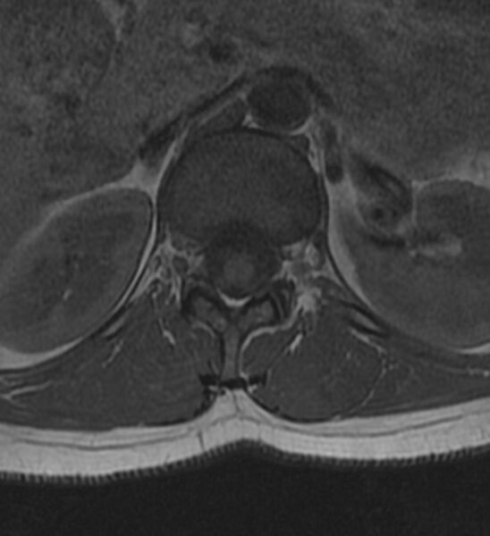 File:Normal thoracic spine MRI (Radiopaedia 41033-43781 Axial T1 32).jpg