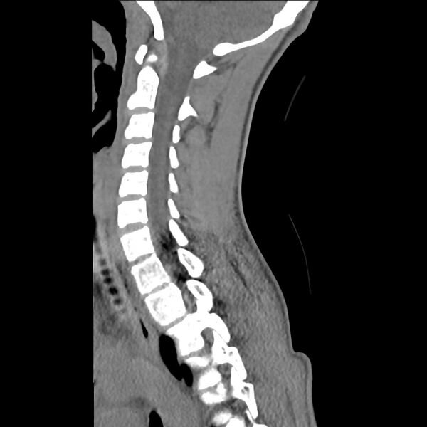 File:Normal trauma spine imaging (age 16) (Radiopaedia 45335-49358 C 23).jpg