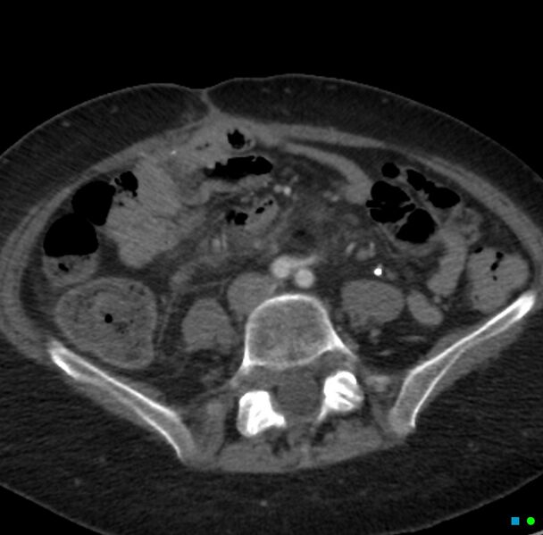 File:Obstructed infected horseshoe kidney (Radiopaedia 18116-17898 B 26).jpg