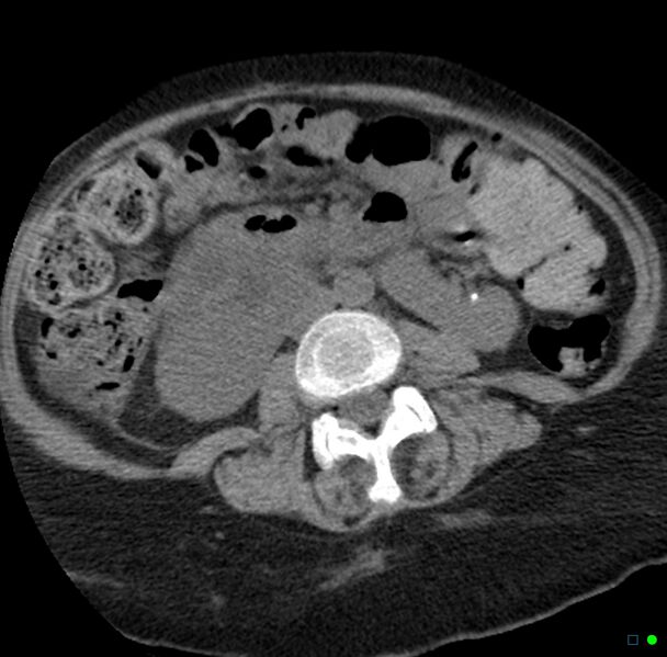 File:Obstructed infected horseshoe kidney (Radiopaedia 18116-17898 non-contrast 15).jpg