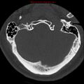 Occipital condyle fracture (Radiopaedia 18366-18208 Axial bone window 6).jpg