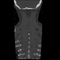 Occipital condyle fracture (Radiopaedia 31755-32691 Coronal bone window 36).jpg