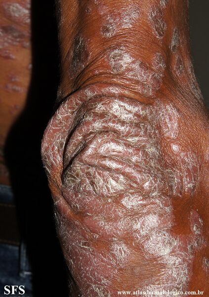 File:Psoriasis (Dermatology Atlas 143).jpg