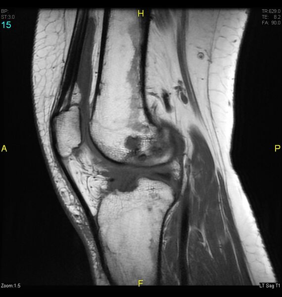 File:ACL mucoid degeration with cystic changes (Radiopaedia 48428-53341 Sagittal T1 13).jpg
