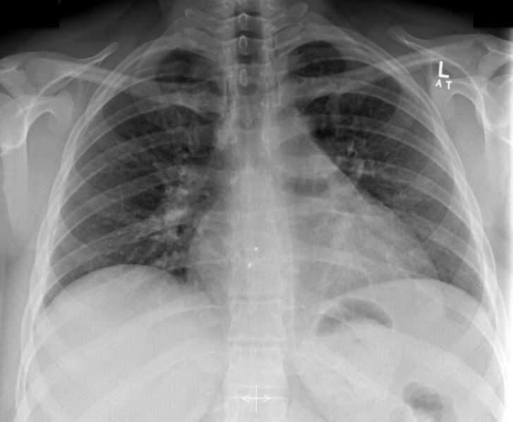 File:ASD closure device on chest radiograph (Radiopaedia 56014-62639 Frontal 1).jpg
