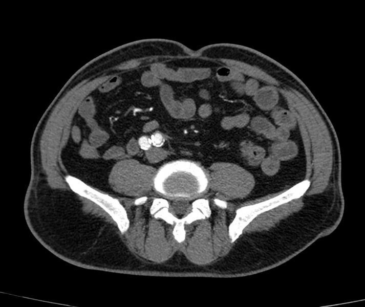 File:Abdominal aortic aneurysm (Radiopaedia 22421-22458 C+ arterial phase 60).jpg