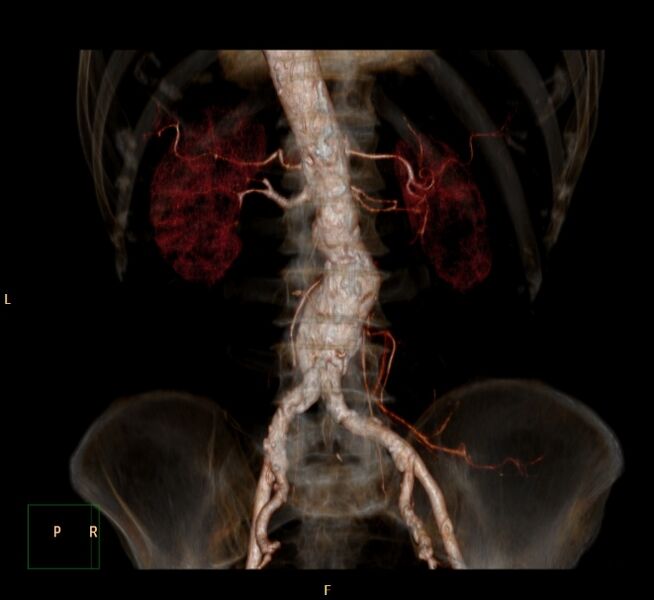 File:Abdominal aortic aneurysm (Radiopaedia 23703-23856 3D 13).jpg