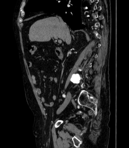 File:Abdominal aortic aneurysm (Radiopaedia 25855-26001 Sagittal C+ arterial phase 10).jpg