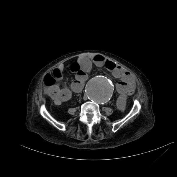 File:Abdominal aortic aneurysm - impending rupture (Radiopaedia 19233-19246 Axial non-contrast 80).jpg