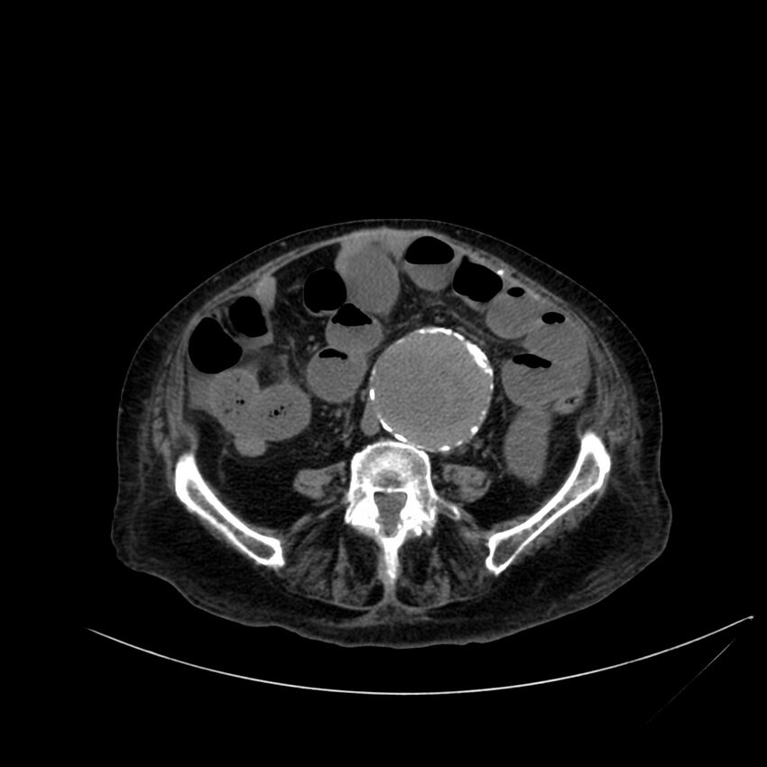 Abdominal aortic aneurysm - impending rupture (Radiopaedia 19233-19246 Axial non-contrast 80).jpg