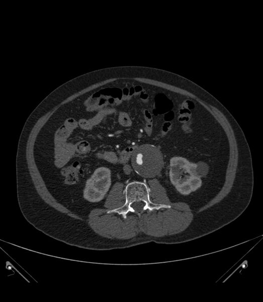 File:Abdominal aortic aneurysm with thrombus fissuration (Radiopaedia 46218-50618 Axial C+ arterial phase 20).jpg