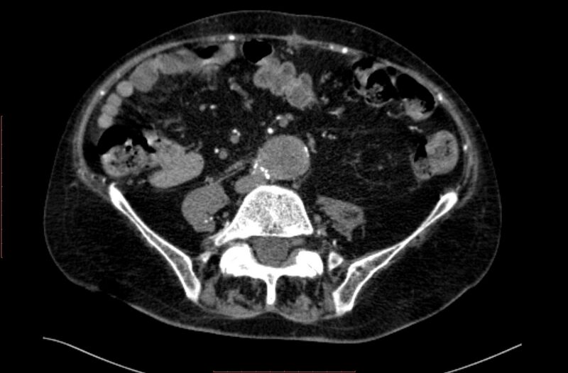 File:Abdominal aortic interposition tube graft and aneurysm thrombosis (Radiopaedia 71438-81857 Axial C+ arterial phase 126).jpg