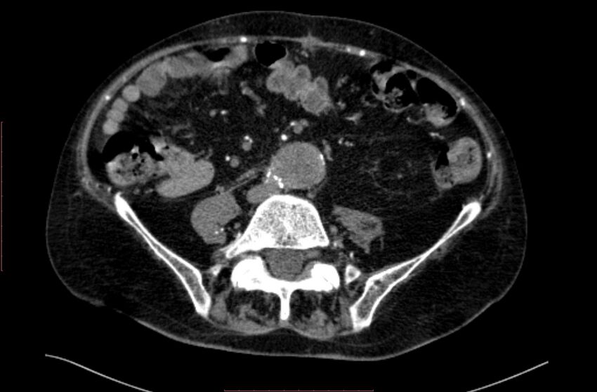 Abdominal aortic interposition tube graft and aneurysm thrombosis (Radiopaedia 71438-81857 Axial C+ arterial phase 126).jpg