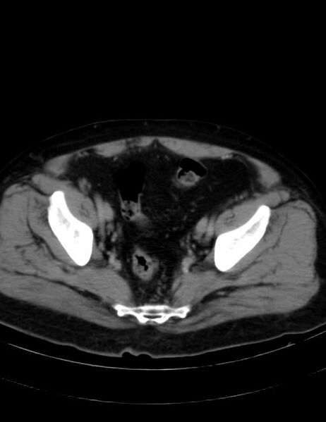 File:Abdominal lymphoma - with sandwich sign (Radiopaedia 53486-59492 Axial C+ portal venous phase 43).jpg