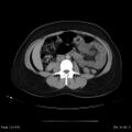 Abdominal wall endometriosis (Radiopaedia 25723-25885 Axial C+ portal venous phase 18).jpg